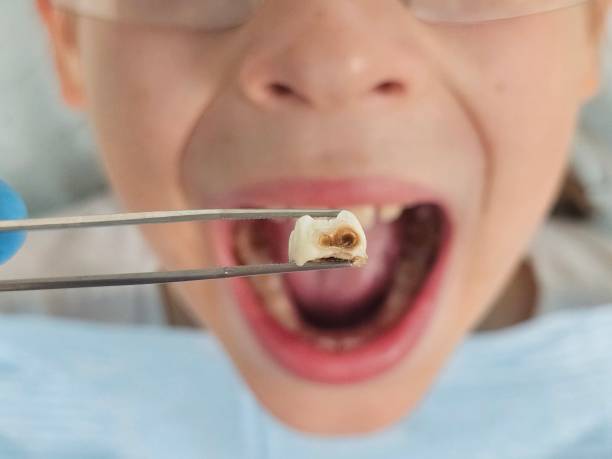 Best Emergency Treatment for Dental Infections or Abscesses in Kingsley, IA
